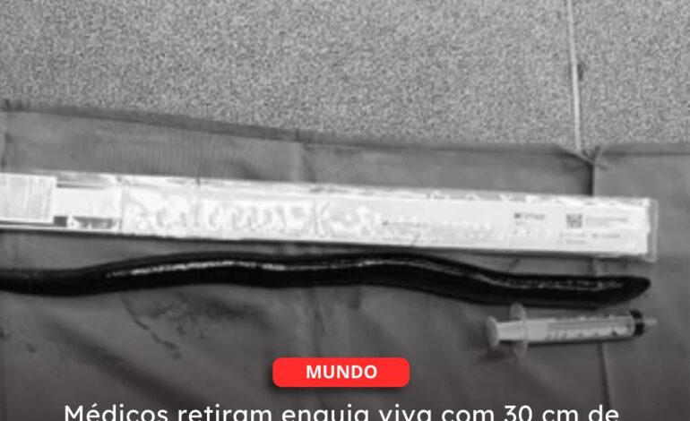  VIETNÃ | Médicos retiram enguia viva com 30 cm de barriga de paciente