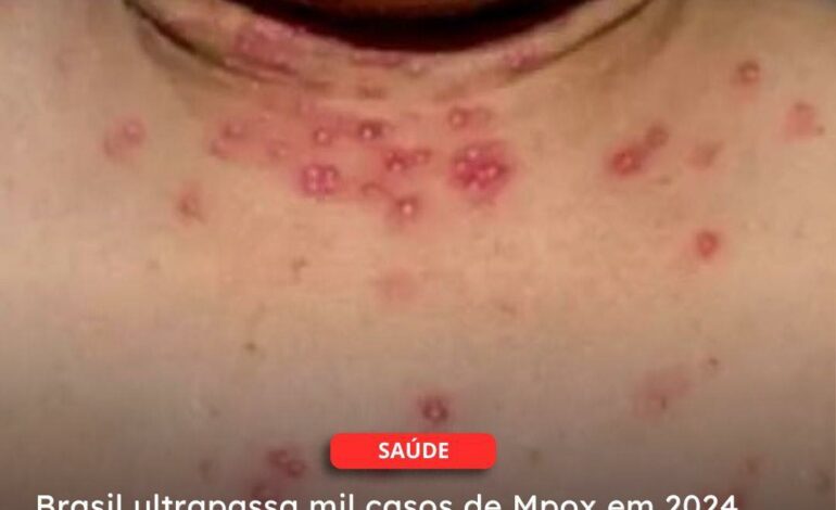  SAÚDE | Brasil ultrapassa mil casos de Mpox em 2024