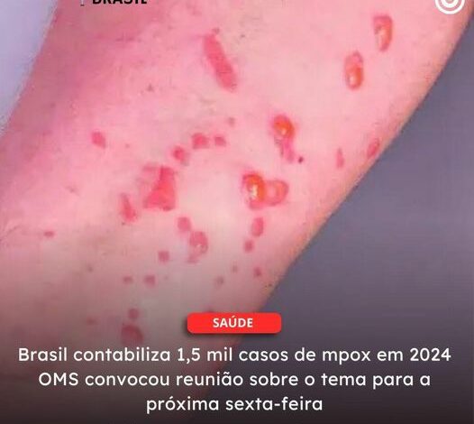  Brasil contabiliza 1,5 mil casos de mpox em 2024 OMS convocou reunião sobre o tema para a próxima sexta-feira